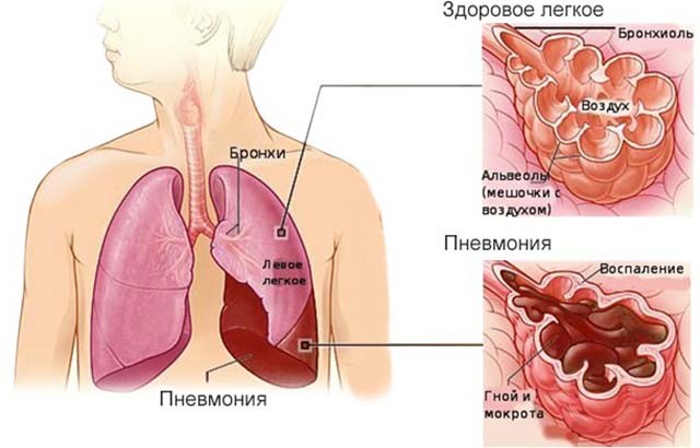 Острая долевая пневмония особенности течения в пожилом возрасте