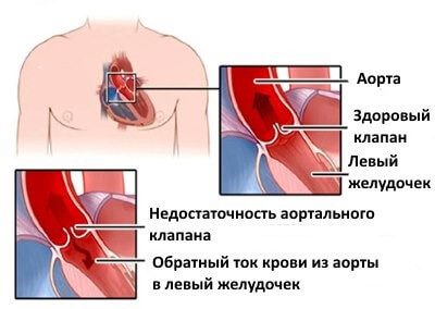 Особенности артериальной гипертонии у пожилых