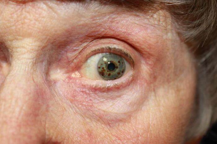 Глаукома у мужчин 50 лет