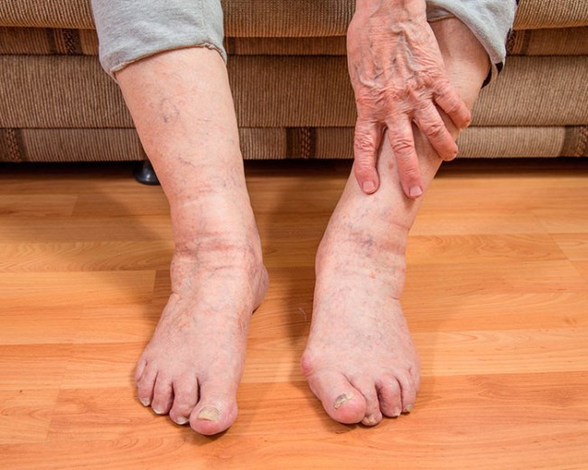 Мерзнут ноги у пожилых лечение