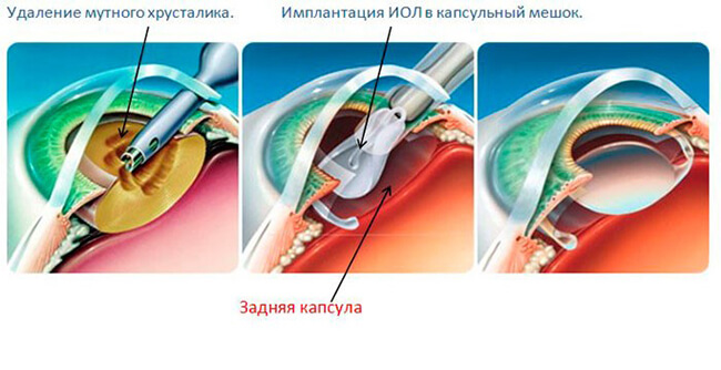 Операция при катаракте